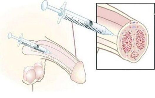 Hyaluronic acid injection suspension