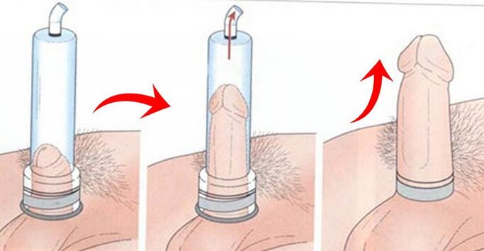 using a penis enlargement pump
