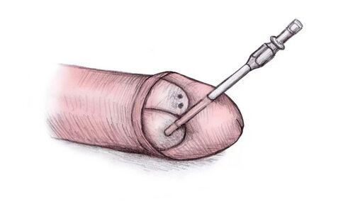The head of the penis can be enlarged by injecting hyaluronic gel into it