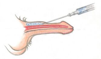Extensive injection of hyaluronic acid into the penis